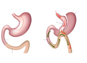 mini gastric bypass