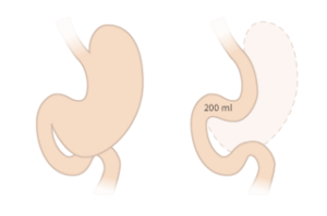 gastric sleeve operation