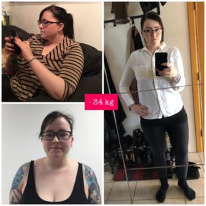 Before and after bariatric surgery in Tallinn