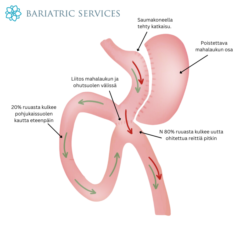 Uuden Leikkausmenetelm n Ohitus Kavennusleikkaus Bariatric Services uuden-leikkausmenetelm-n-ohitus-kavennusleikkaus-bariatric-services